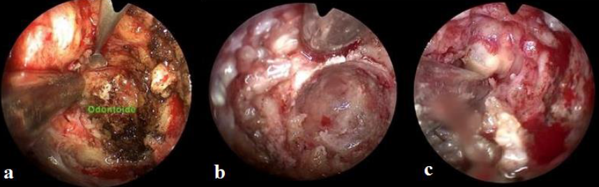 Imagen endoscópica a. Exposición de la apófisis odontoides, b. Cavitación de la odontoides a fin de extraer la misma como una fina cáscara, c. Liberación completa del canal espinal luego de extraerla odontoides.