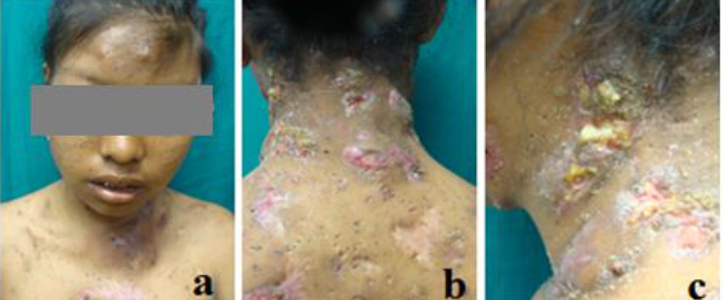 a. Afectación de rostro y tórax anterior. b. Afectación de nuca. c. Afectación de base de cuello con secreción purulenta.